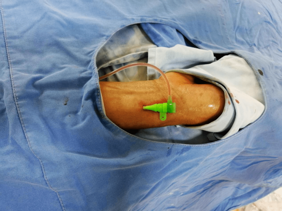 用两根具有不同头端形态可以适应左右侧不同解剖结构的造影导管,在