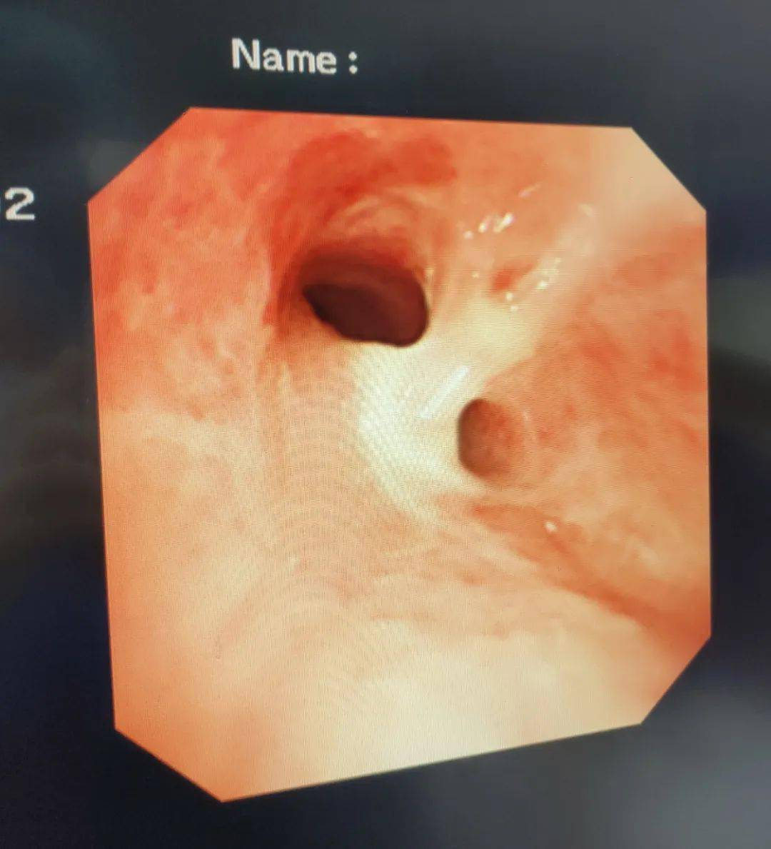 两处致命伤6科室专家抢救鱼刺卡喉求你们别再用土方法了