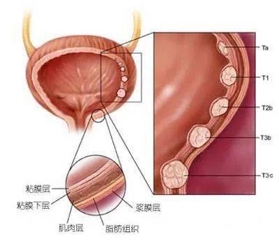 因此,大家需要了解结石的早期症状,帮助判断是否已经患上结石