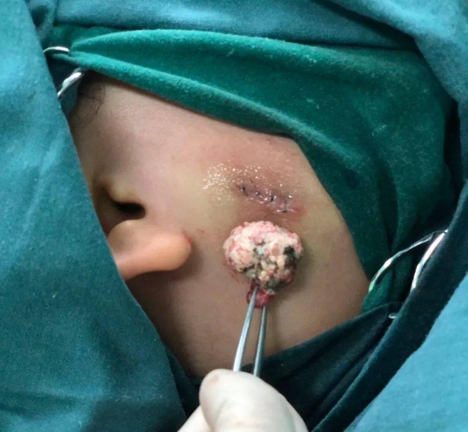 抗击疫情复工复产孩子脸上长石头家长急得皱眉头