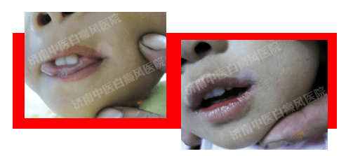 起初孩子嘴角是没有白斑的,后来发现孩子嘴角处有一点点白,当时没有太