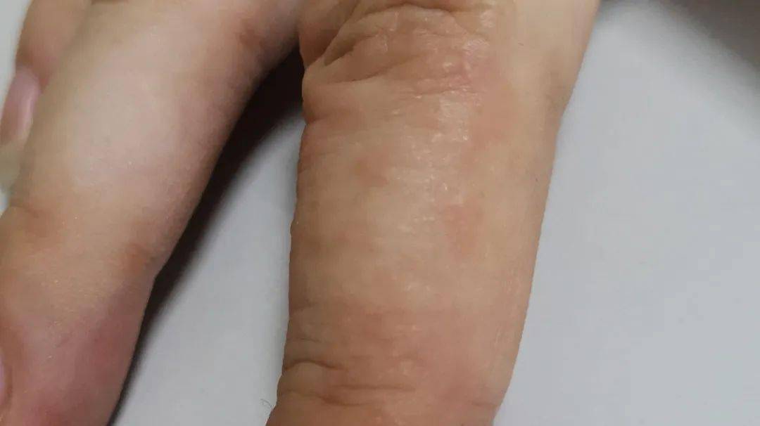 最近很多人都长了这种夏天磨人的小妖精小孩和青年人高发