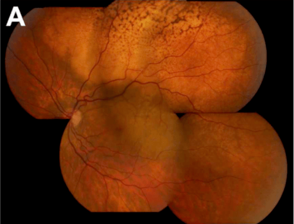 中国之声丨孙大卫教授:玻璃体腔注射抗vegf药物治疗脉络膜转移癌的