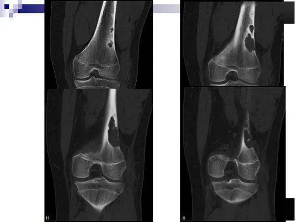 股骨非骨化性纤维瘤图片