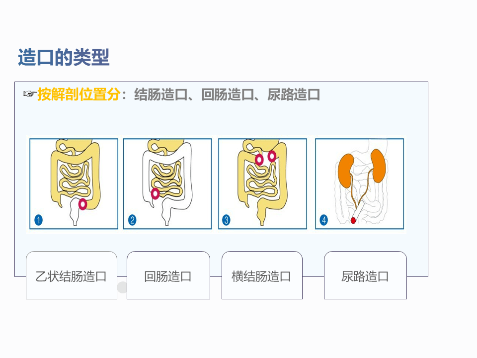 肠造口分类图片