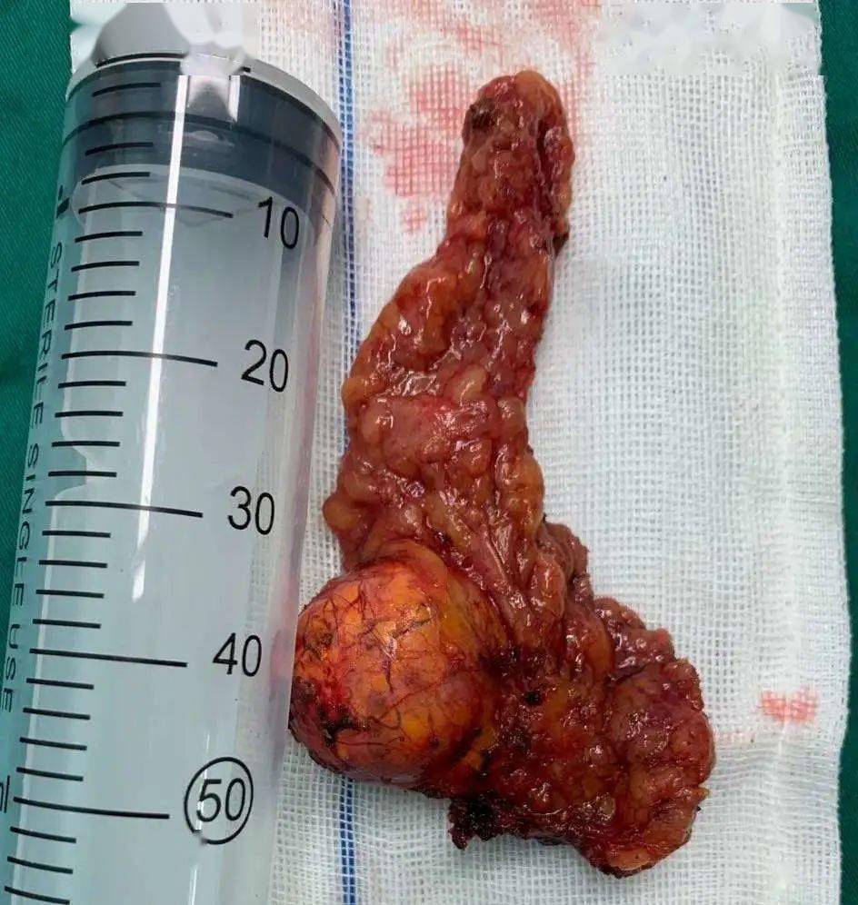 组cp吗达芬奇医生和泌尿外科联手摘除肾上腺肿瘤