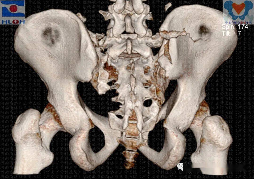 3 )(經骶骨左翼 denis2 區的垂直不穩定型骨折,經骶骨右翼壓縮骨折及