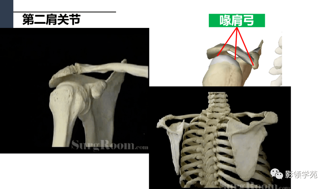 鑑別診斷——肩峰下大結節骨折鈣化性肌腱炎岡上肌鈣化性肌腱炎肩胛下