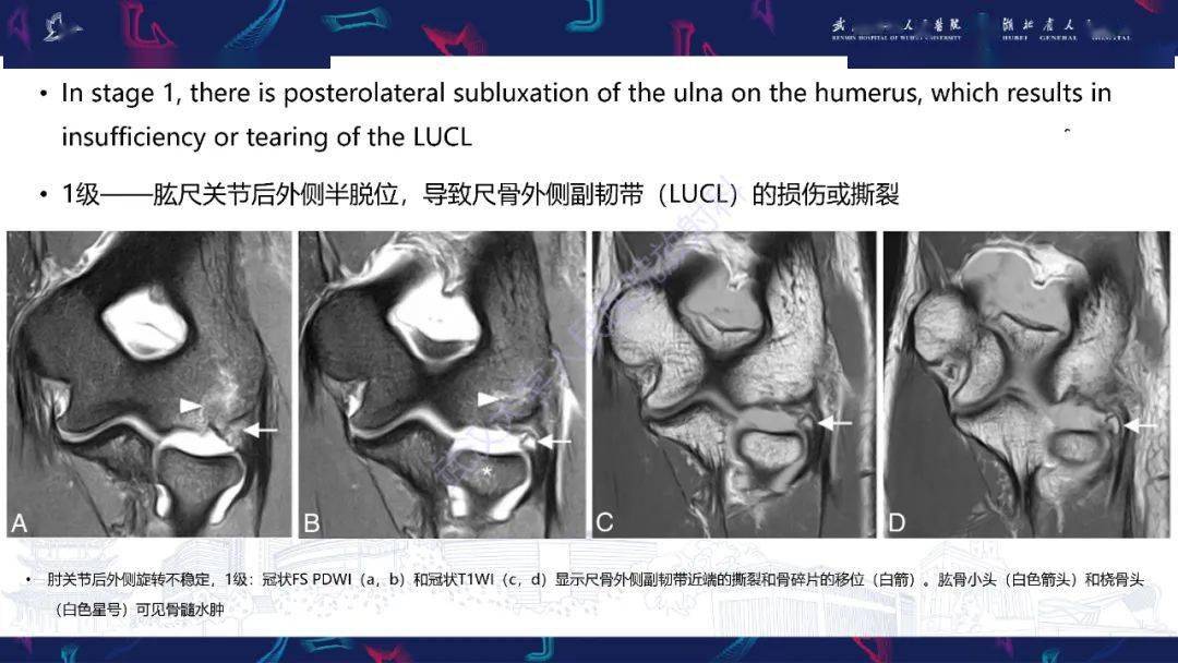 肘关节mri解剖及侧副韧带复合体常见损伤下