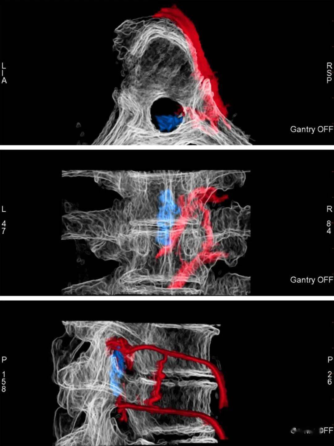 急诊在杂交手术室行脊髓血管造影术 后正中入路硬脊膜动静脉瘘瘘口