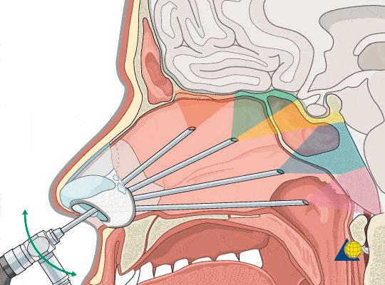 the whole central compartment of the skull base, from the crista