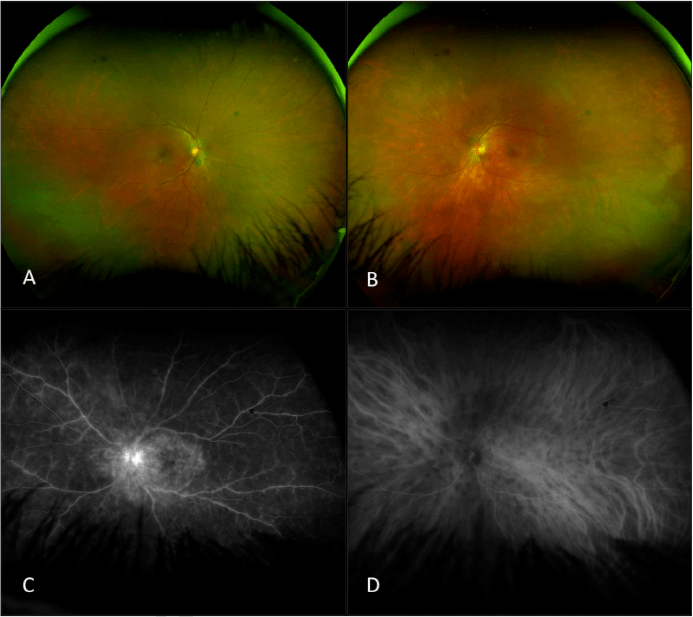 惟视讲堂一文读懂视网膜血管炎的最新分类