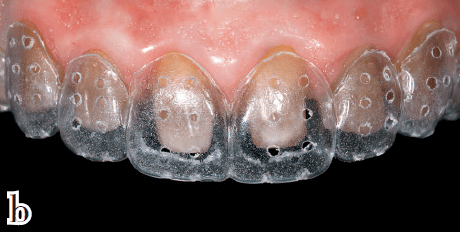 减少软组织创伤的牙体预备方案全冠及固定桥的预备体终止线