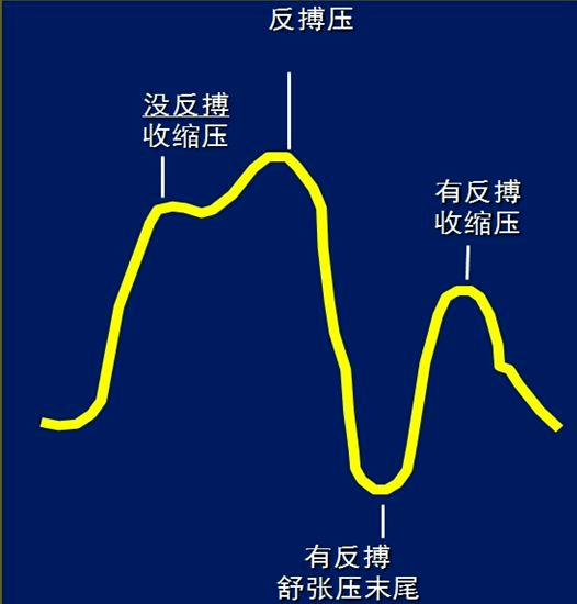 【航天心学术】手把手教你如何调整iabp球囊工作,化解临床问题.