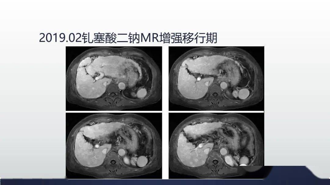 肝膽期攝取,考慮肝硬化結節rn或dn,一般來說dn肝動脈血供會增加,直徑1