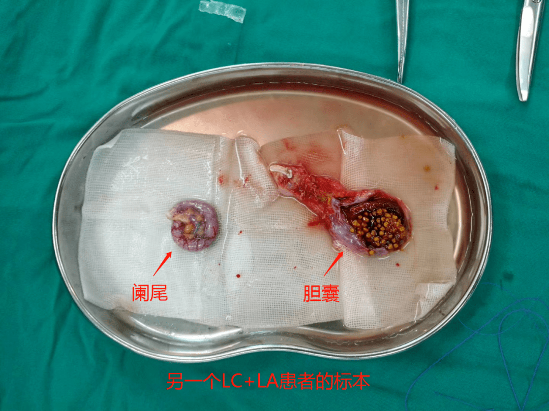 应该在腹腔镜手术基础上,术中找对层面,减少出血,尽量不切入或烧灼