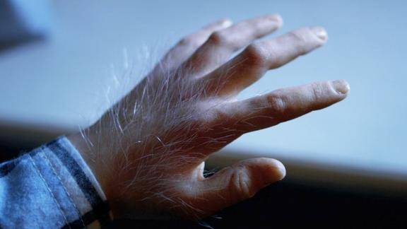 小男孩每到月圆之夜手上就开始长毛身体也发生了可怕的变化