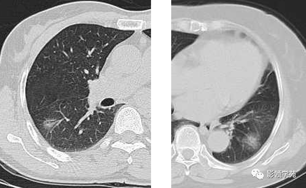 肺泡癌影像诊断与鉴别诊断