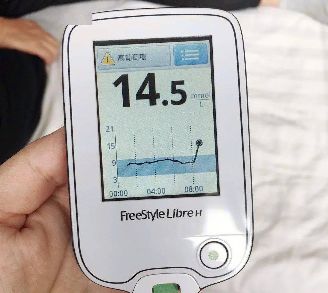 测血糖不痛有木有有瞬感血糖监测系统了解一下