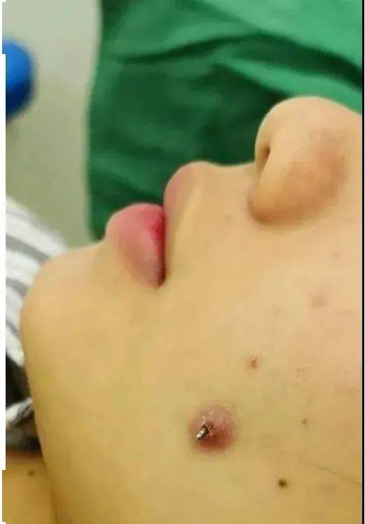 为"长"出酒窝,这位女子竟然在脸上打钉子!事发龙岩!