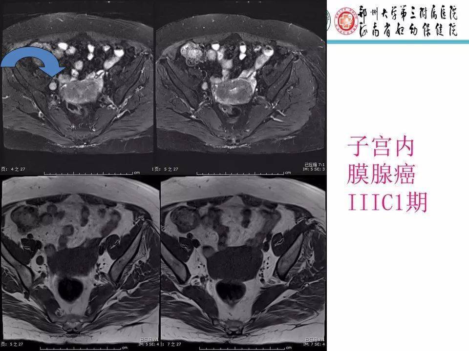 子宫常见肿瘤的mri表现