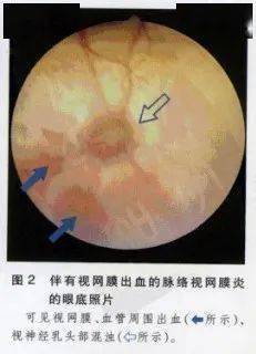 眼疾症状一般易于被忽略,以视网膜脱落为例,当失明后才被发现.