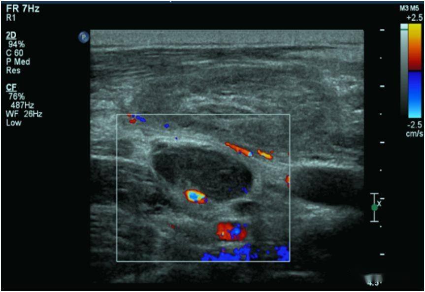 超声典型病例:特殊的颈部肿块_淋巴结