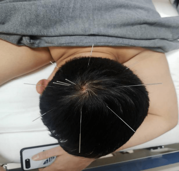 新中医筋膜三才针治疗肾病综合症案例