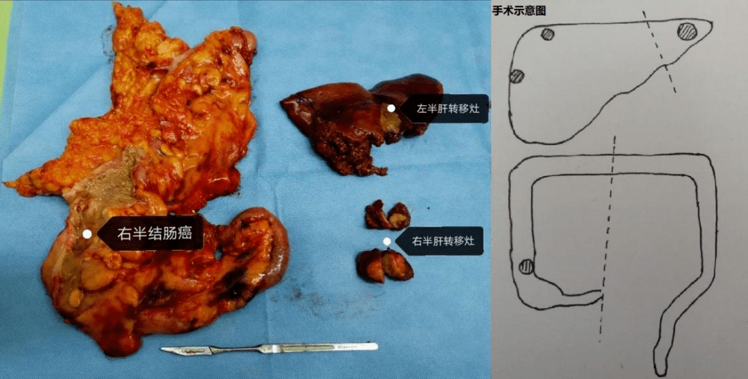 哈醫大二院結直腸腫瘤外科多臟器切除noses手術再創新高治療結腸癌肝