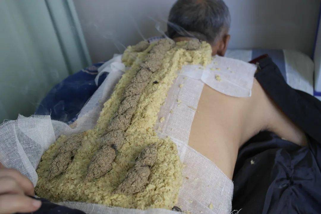 冬病夏治正当时市中心医院中医科特色疗法督脉灸火热预约中