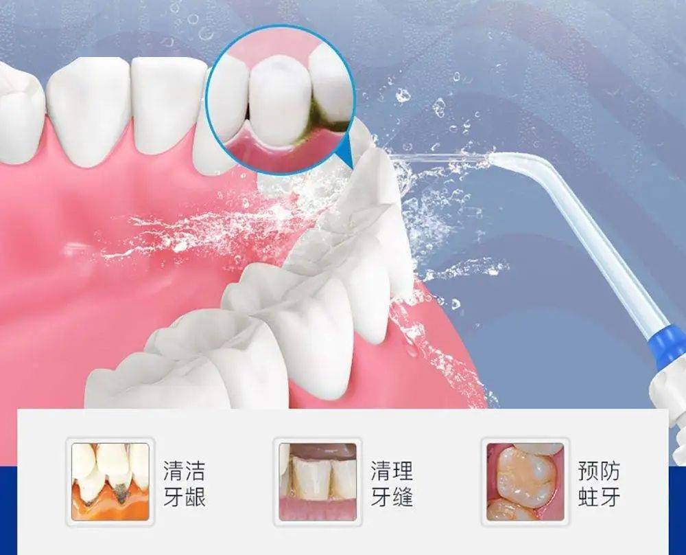 牙齒天天刷就不用洗洗牙的四大誤區你瞭解嗎