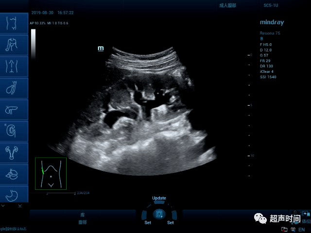 输尿管狭窄超声图片