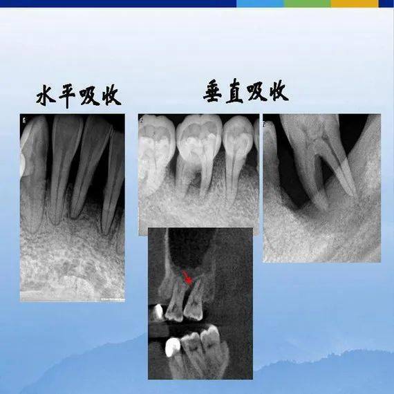 牙体牙周正常解剖及常见病x线表现