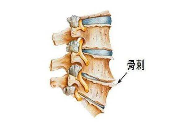 【科普】长骨刺是钙太多了了吗?