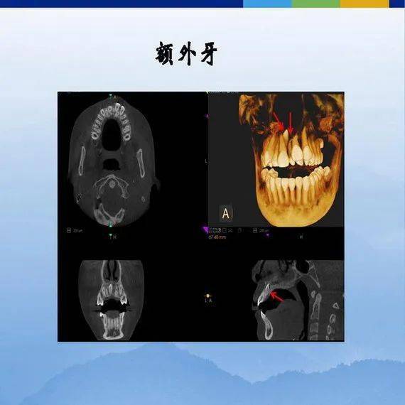 牙體牙周正常解剖及常見病x線表現