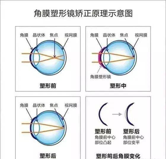 睡觉就能矫正近视带您全面了解角膜塑形镜