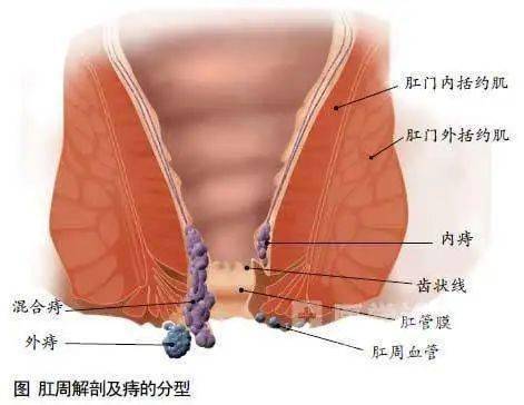 静脉曲张性外痔:肛缘周围皮下曲张的静脉团,下蹲腹压增加,排便时增大