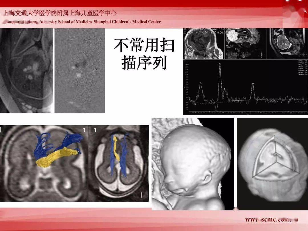 胎兒磁共振的檢查技術