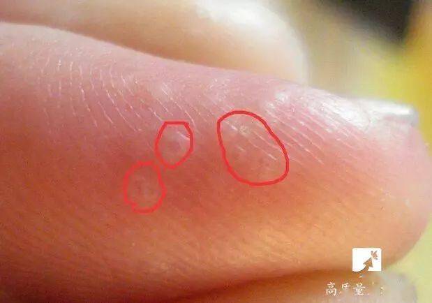 精神因素(如焦虑,熬夜等);接触过敏原(如镍,联苯胺,呋喃西林,重铬酸钾