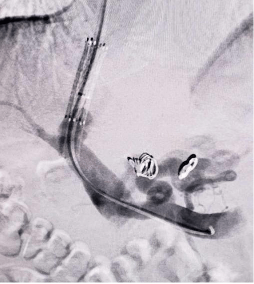 西北专栏|董方:甘肃省人民医院血管外科改良tips手术微创治疗肝硬化失