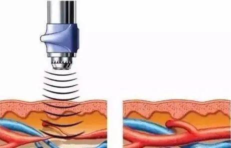 广泛的压痛,上举,后伸明显受限,也就意味着连梳头,穿脱衣服都费劲了