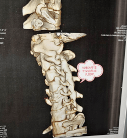 颈椎反弓竟是因为长期的这个动作