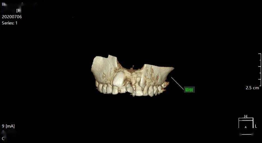 張xx20200706多生牙cbct139xxxx6102