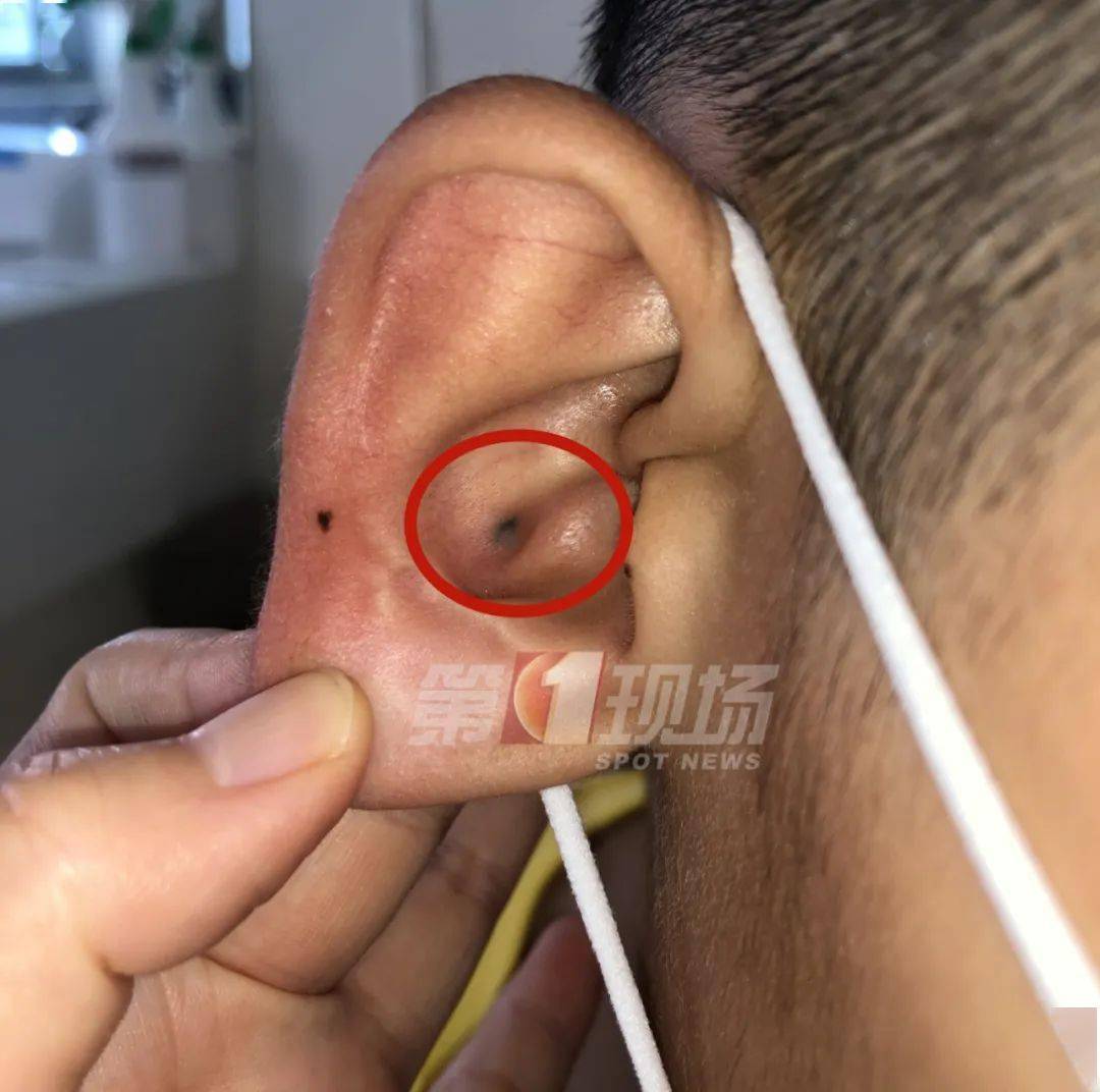 外耳道寻常疣图片