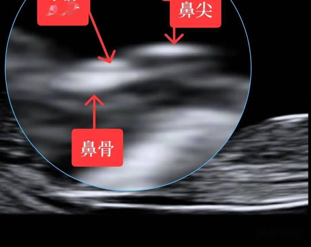 没有鼻骨正常人图片图片