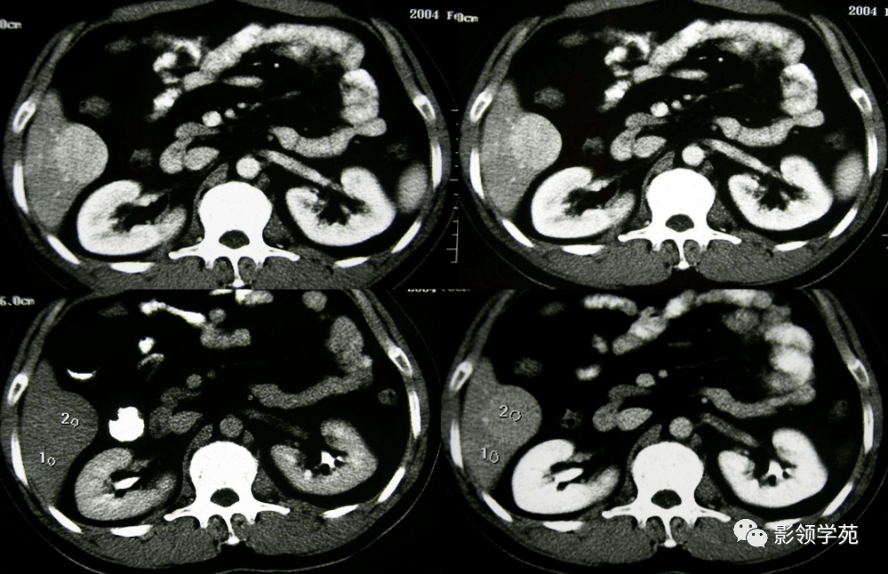 总结:肝脏炎性假瘤发病率低,但病变表现多样化,较易与肝细胞癌