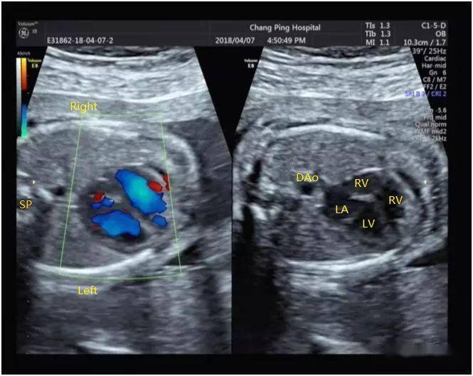 超声典型病例胎儿法洛四联症合并右位主动脉弓