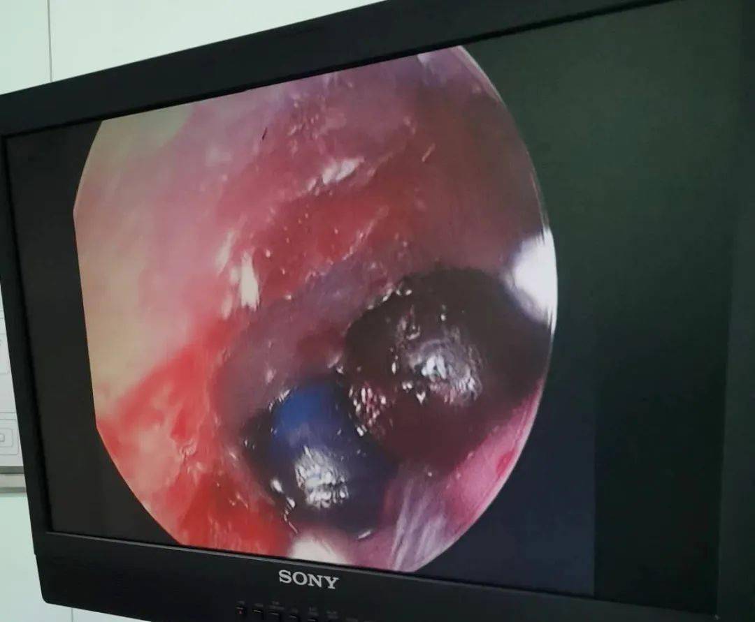 可当医生用耳内镜再次检查时,隐约发现在鼓膜凹陷的位置有一个红色的
