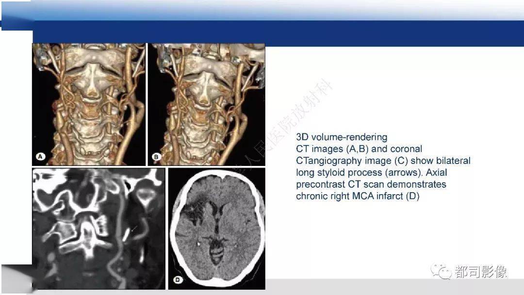 茎突综合征影像诊断