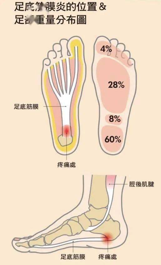 足底筋膜炎的位置图图片